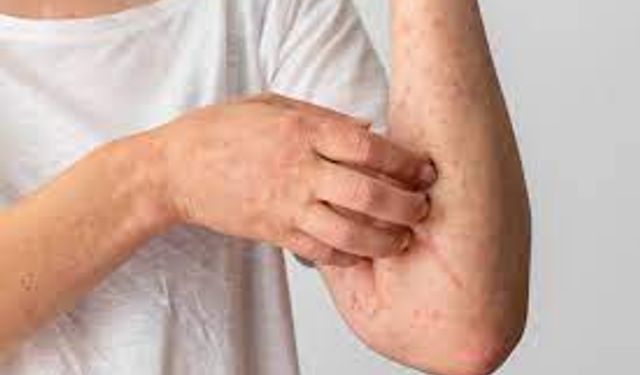 Yaz Alerjisi: Tatilinizi Tehdit Eden Görünmez Düşman!